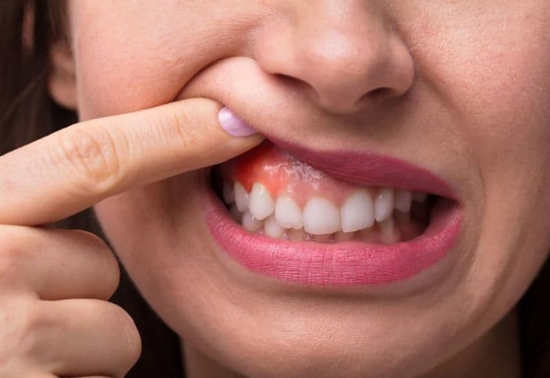 điều trị viêm lợi bằng máng