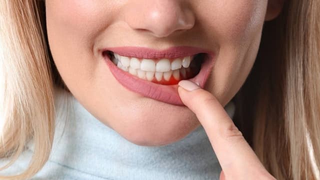 Cách điều trị viêm lợi bằng máng