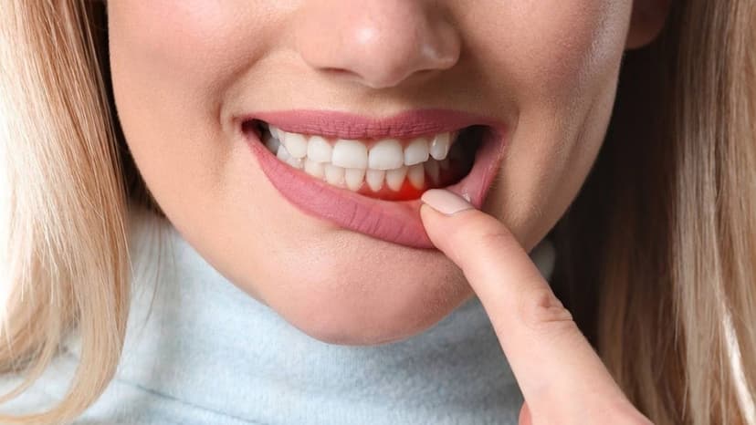 Cách điều trị viêm lợi bằng máng