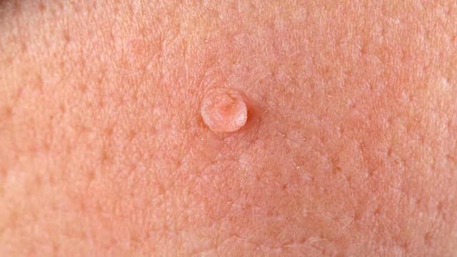 Đốt sùi mào gà ở Thanh Trì: Nên điều trị khi nào và ở đâu uy tín?