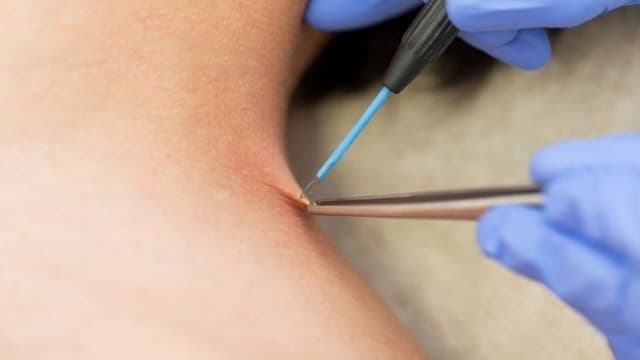 Đốt sùi mào gà ở Hoàng Mai: Những điều cần biết trước khi điều trị