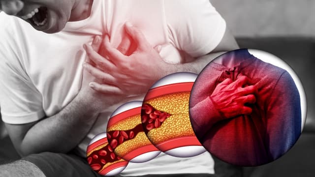 Hậu quả của xơ vữa mạch máu đối với người bệnh