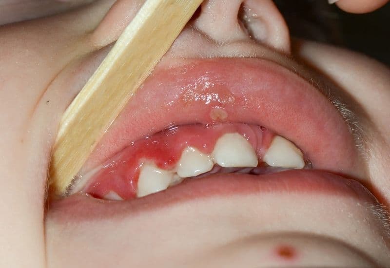 hình ảnh viêm lợi ở trẻ em