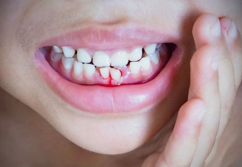 hình ảnh viêm lợi ở trẻ em