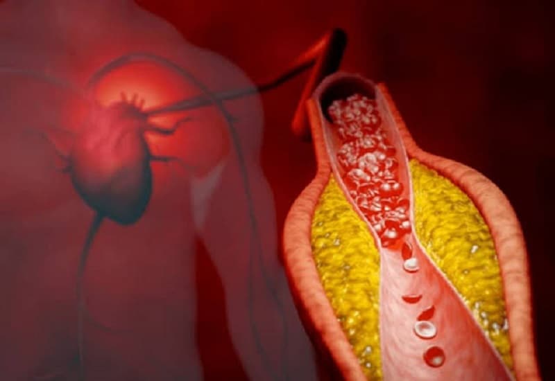 xơ vữa động mạch vành