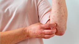 Nên khám giang mai ở Thanh Trì tại đâu chính xác và kín đáo?