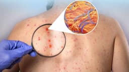 Khám giang mai ở Linh Đàm: Phát hiện và chữa trị sớm
