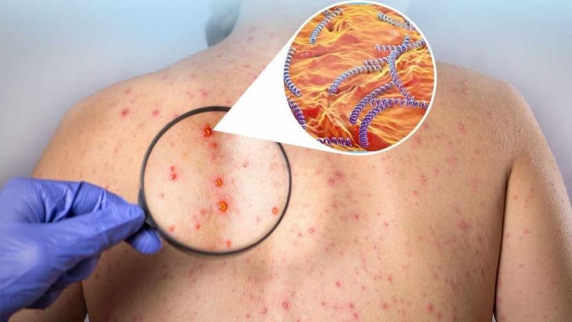 Khám giang mai ở Linh Đàm: Phát hiện và chữa trị sớm