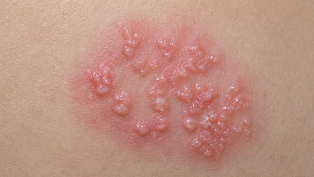 Khám mụn rộp sinh dục ở Thanh Trì tại đâu uy tín, quy trình nhanh chóng và bảo mật?