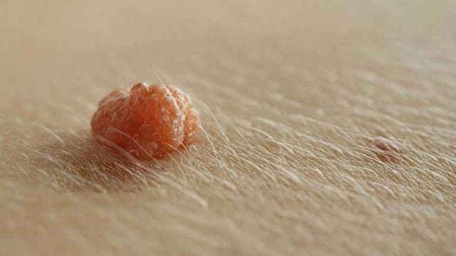 Khám sùi mào gà ở Đại Từ tại đâu uy tín và nhanh chóng?