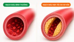 Đặc điểm mạch máu bị hẹp hoặc tắc do xơ vữa