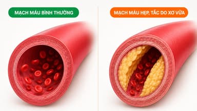 Đặc điểm mạch máu bị hẹp hoặc tắc do xơ vữa