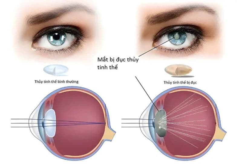 mắt bị mờ như có màng che phải làm sao