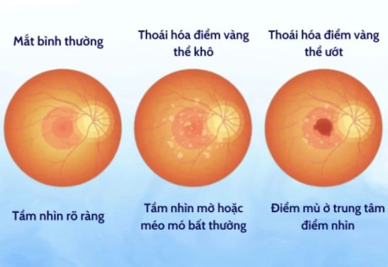 mắt bị mờ như có màng che phải làm sao