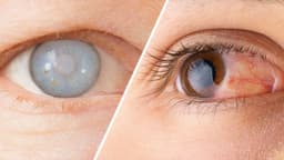 Mắt bị mờ như có màng che phải làm sao?