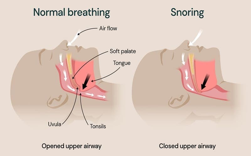 ngủ ngáy to là hiện tượng gì