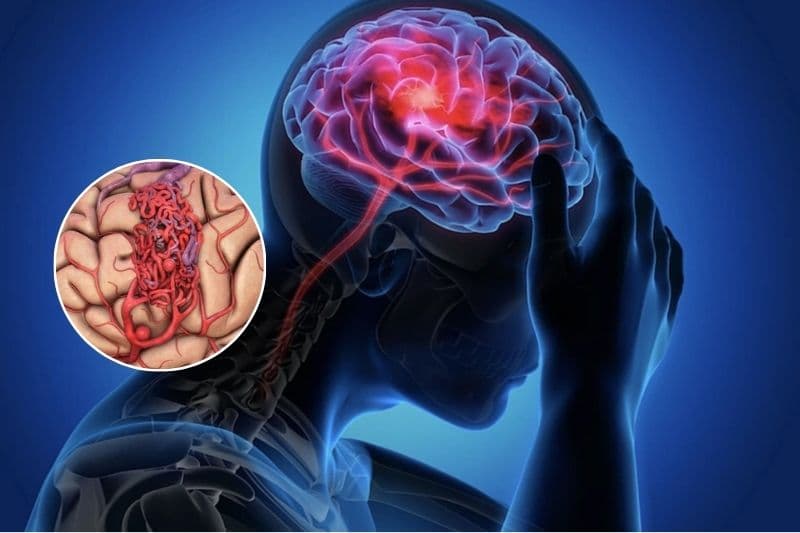 xuất huyết não ở người trẻ