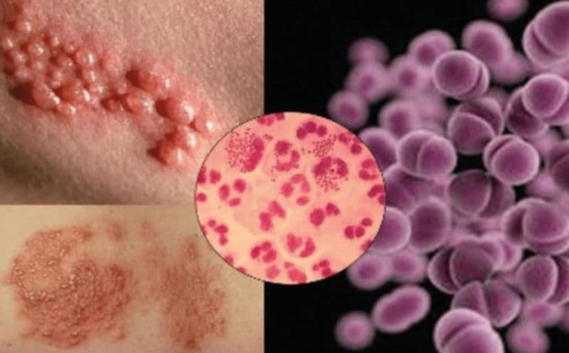 Bác sĩ giỏi chữa chlamydia