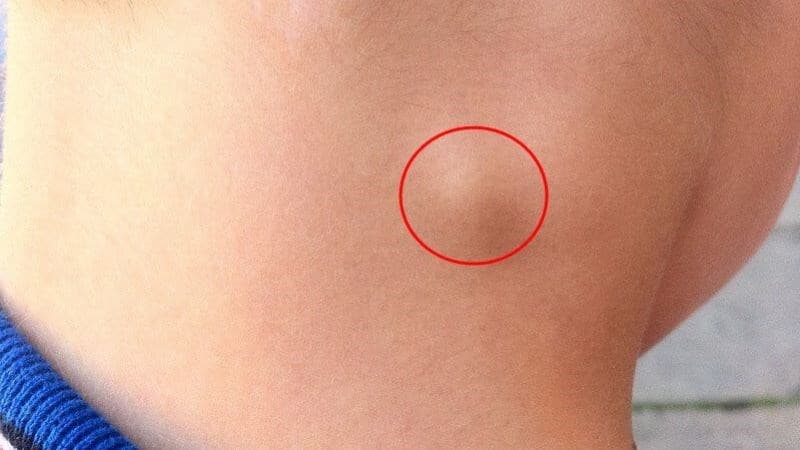 dấu hiệu ung thư tuyến giáp ở nam