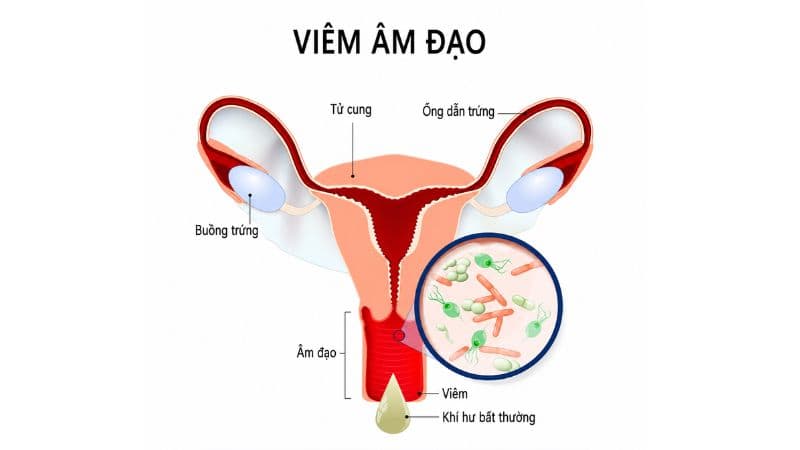 phòng khám viêm âm đạo ở vĩnh phúc