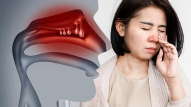 Polyp mũi có gây ung thư không? Giải đáp