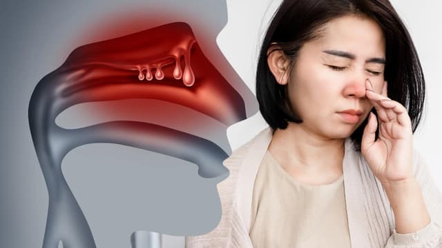 Polyp mũi có gây ung thư không? Giải đáp