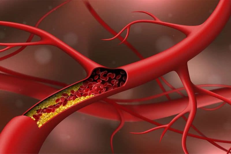 quá trình hình thành mảng xơ vữa mạch máu