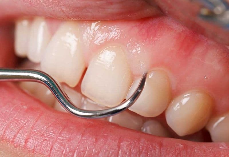 Có phải răng bị thưa sau khi lấy cao răng?