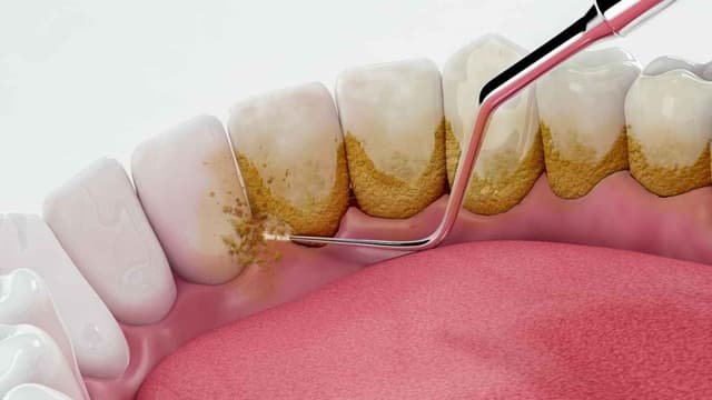 Có phải răng bị thưa sau khi lấy cao răng?