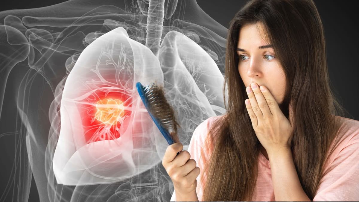 Rụng tóc có phải ung thư không?