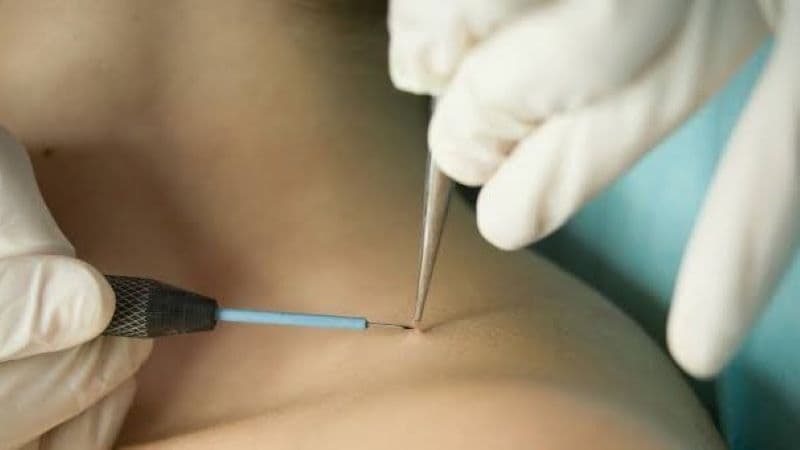 Chi phí điều trị sùi mào gà