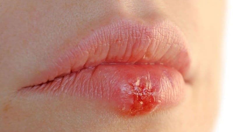 Xét nghiệm mụn rộp sinh dục