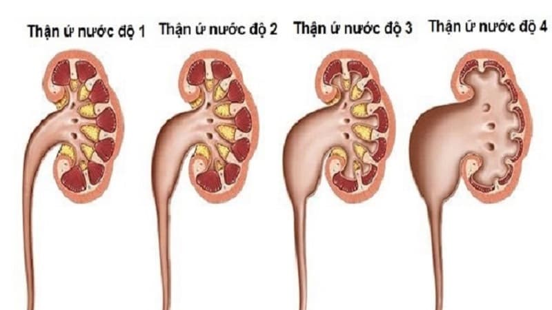Thận ứ nước độ 3 4 có chữa được không?