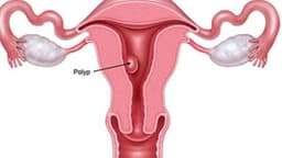 Bị polyp tử cung có nguy hiểm không và câu trả lời