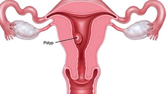 Bị polyp tử cung có nguy hiểm không và câu trả lời