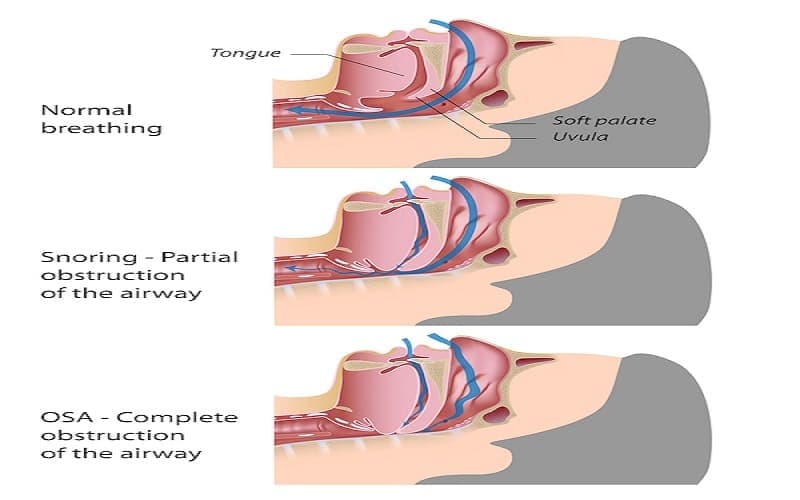 trẻ em ngủ ngáy là bệnh gì