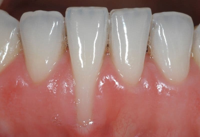 tụt lợi có hồi phục được không