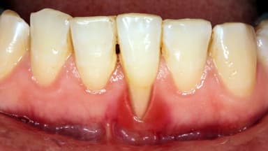 Bị tụt lợi có hồi phục được không?