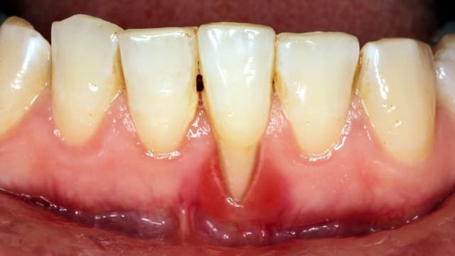 Bị tụt lợi có hồi phục được không?