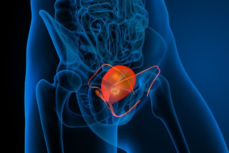 dấu hiệu ung thư bàng quang giai đoạn đầu