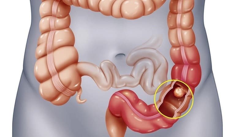 dấu hiệu ung thư đại tràng giai đoạn 0