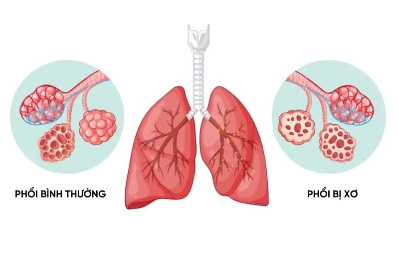xơ phổi có phải ung thư không