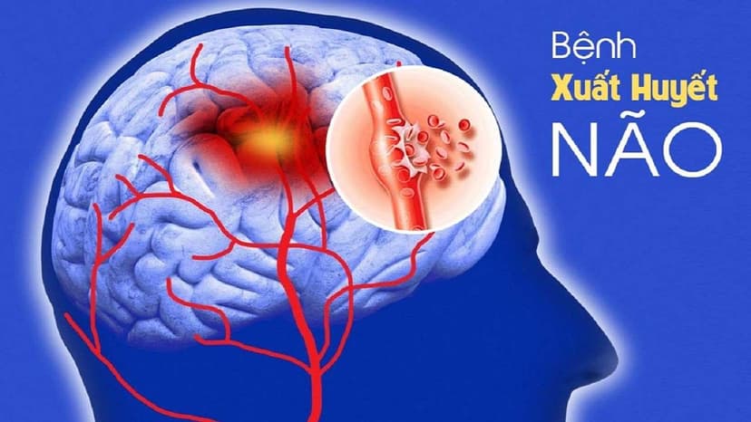 Vị trí xuất huyết não do tăng huyết áp