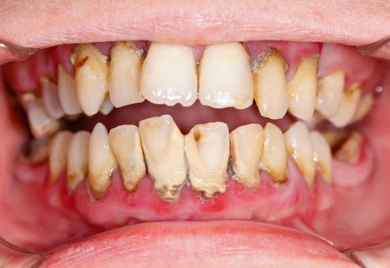 Viêm lợi có tự khỏi được không?