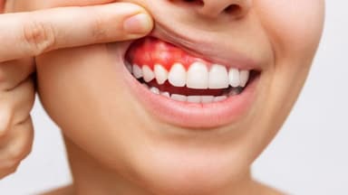 Viêm lợi có tự khỏi được không?