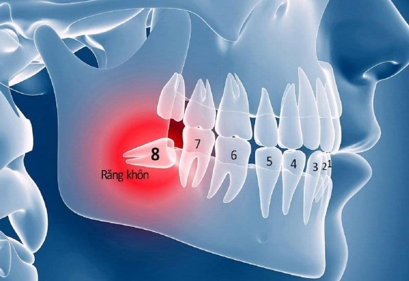 viêm lợi trùm mọc răng khôn bị sưng má