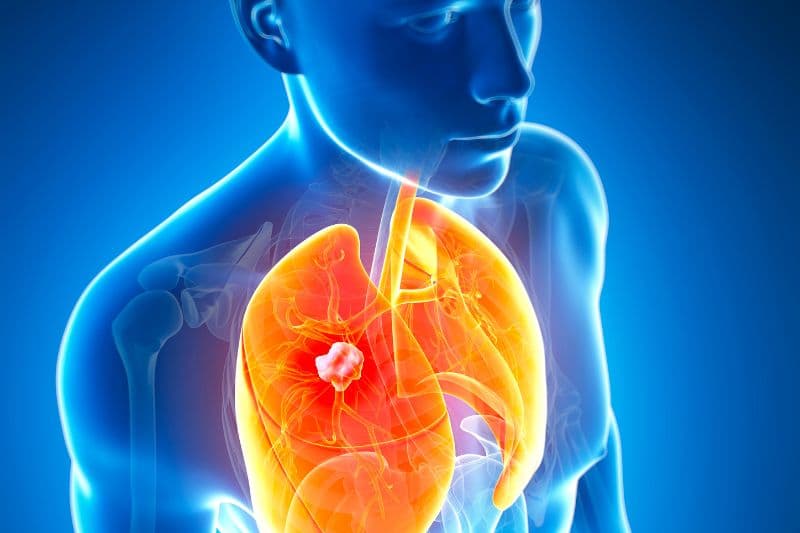 xơ phổi có phải ung thư không
