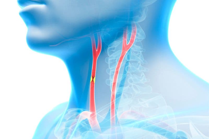 mạch máu bị hẹp hoặc tắc do xơ vữa