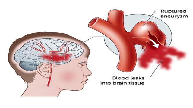 Xuất huyết não có hồi phục được không?