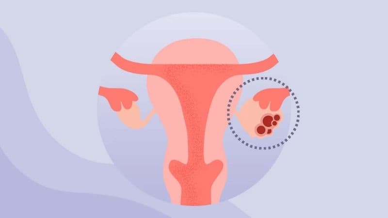 U nang buồng trứng có thể hình thành khi quá trình phát triển và rụng trứng bị gián đoạn. 